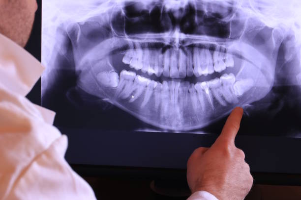 Best Emergency Wisdom Teeth Removal in Los Luceros, NM